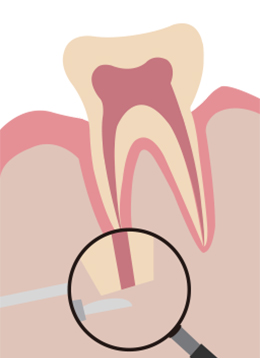 치근단절제술